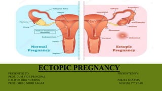 ECTOPIC PREGNANCY
PRESENTED TO: PRESENTED BY:
PROF. CUM VICE PRINCIPAL
H.O.D OF OBG NURSING NIKITA SHARMA
PROF. (MRS.) NIDHI SAGAR M.SC(N) 2ND YEAR
 