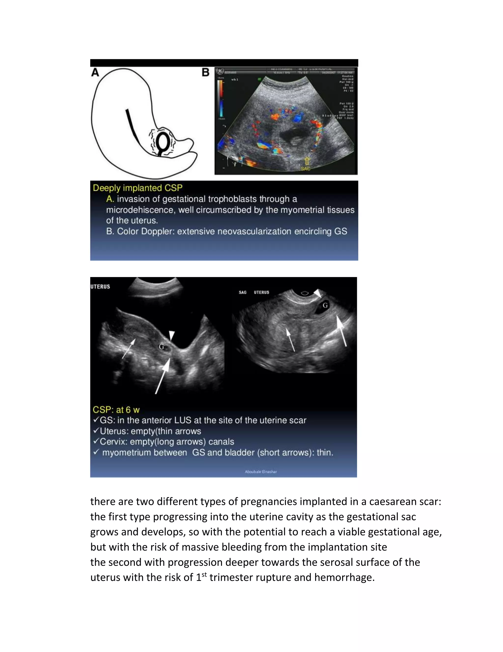 ECTOPIC PREGNANCY.docx