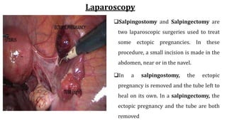 Laparoscopy
Salpingostomy and Salpingectomy are
two laparoscopic surgeries used to treat
some ectopic pregnancies. In these
procedure, a small incision is made in the
abdomen, near or in the navel.
In a salpingostomy, the ectopic
pregnancy is removed and the tube left to
heal on its own. In a salpingectomy, the
ectopic pregnancy and the tube are both
removed
 