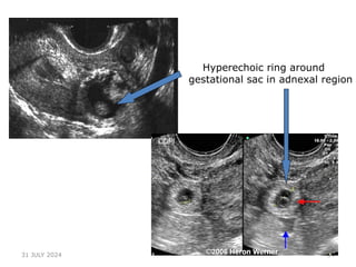 34
Hyperechoic ring around
gestational sac in adnexal region
31 JULY 2024
 