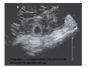 35
Ring sign — a hyperechoic ring around an
extrauterine gestational sac.
31 JULY 2024
 