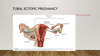 TUBAL ECTOPIC PREGNANCY
 