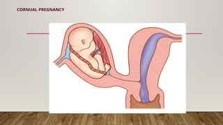 CORNUAL PREGNANCY
 