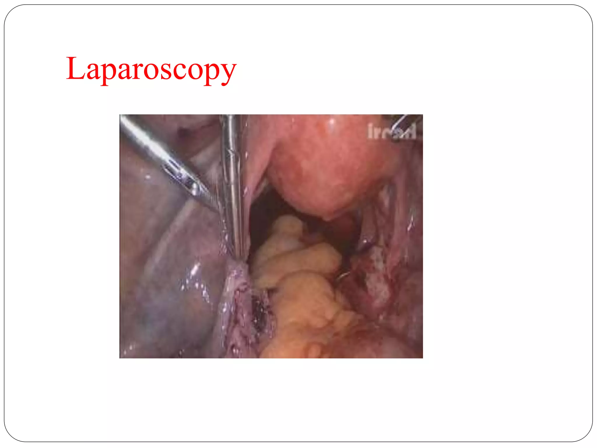 Laparoscopy
 