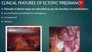 CLINCAL FEATURES OF ECTOPIC PREGNANCY
 Clinically 3 distinct types are described as per the duration of manifestation:
 Acute/Ruptured (obstetric) emergency
 Unruptured
 Chronic
 