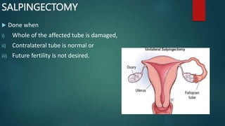 SALPINGECTOMY
 Done when
i) Whole of the affected tube is damaged,
ii) Contralateral tube is normal or
iii) Future fertility is not desired.
 