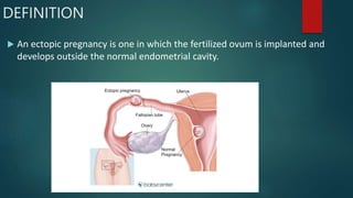 DEFINITION
 An ectopic pregnancy is one in which the fertilized ovum is implanted and
develops outside the normal endometrial cavity.
 