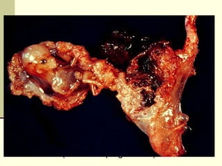 Ectopic Pregnancy
 Definition: It is defined as an implantation of a
conceptus outside the normal uterine cavity
Or
 In theory, any mechanical or functional factors that
prevent or interfere with the passage of the fertilized
egg to the uterine cavity may be aetiological
factors for an ectopic pregnancy.
If not diagnosed on time, it may be life
threatening!!
 Incidence (11.1/1000 pregnancies)
 
