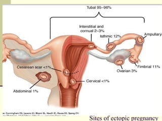 Sites of ectopic pregnancy
 
