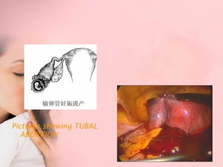 Pictures showing TUBAL 
ABORTION 
 