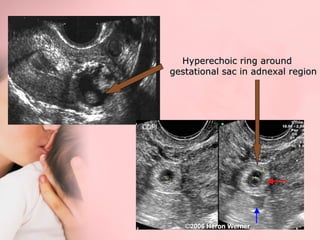 HHyyppeerreecchhooiicc rriinngg aarroouunndd 
ggeessttaattiioonnaall ssaacc iinn aaddnneexxaall rreeggiioonn 
 