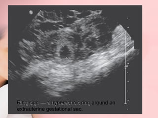 Ring sign —— a hyperechoic ring around an 
extrauterine gestational sac. 
 