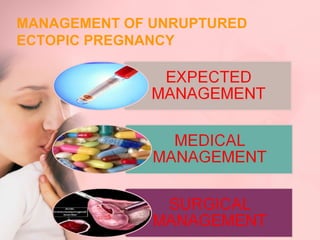 MANAGEMENT OF UNRUPTURED 
ECTOPIC PREGNANCY 
 