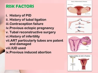 RISK FACTORS 
i. History of PID 
ii. History of tubal ligation 
iii.Contraception failure 
iv.Previous ectopic pregnancy 
v. Tubal reconstructive surgery 
vi.History of infertility 
vii.ART particularly tubes are patent 
and damaged 
viii.IUD used 
ix.Previous induced abortion 
 