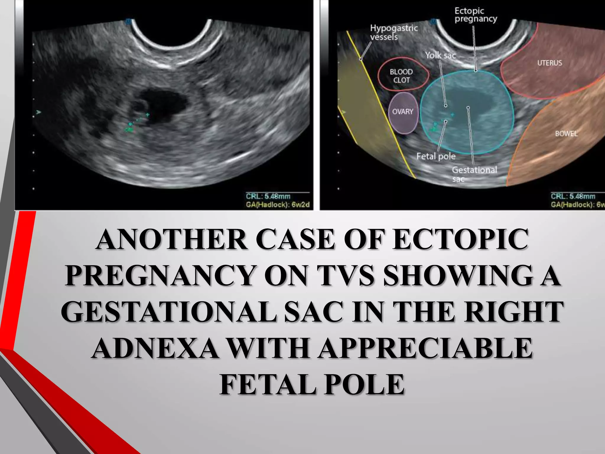 Ectopic pregnancy Radiology | PPT
