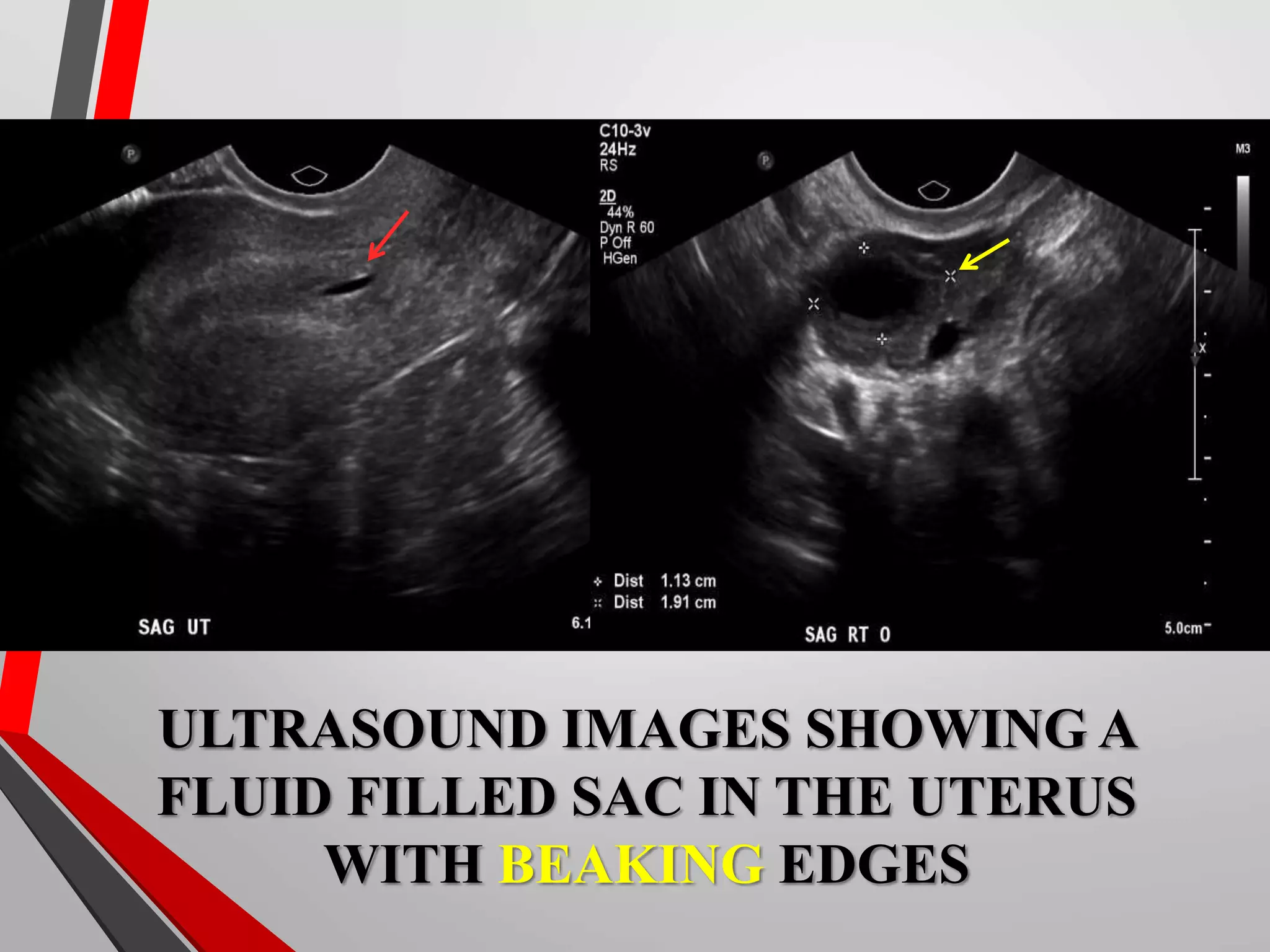 Ectopic pregnancy Radiology | PPT