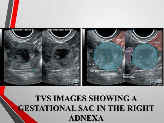 Ectopic pregnancy Radiology | PPT
