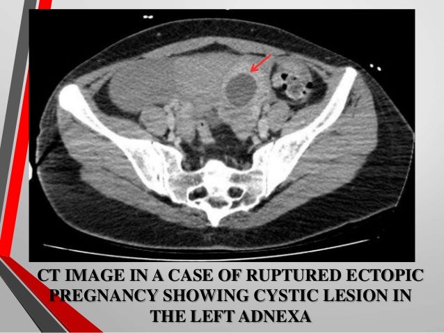 Ectopic pregnancy Radiology