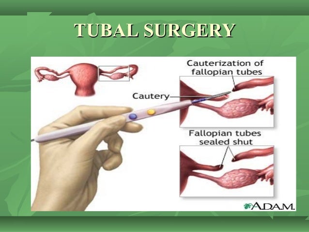 When do ectopic pregnancies occur