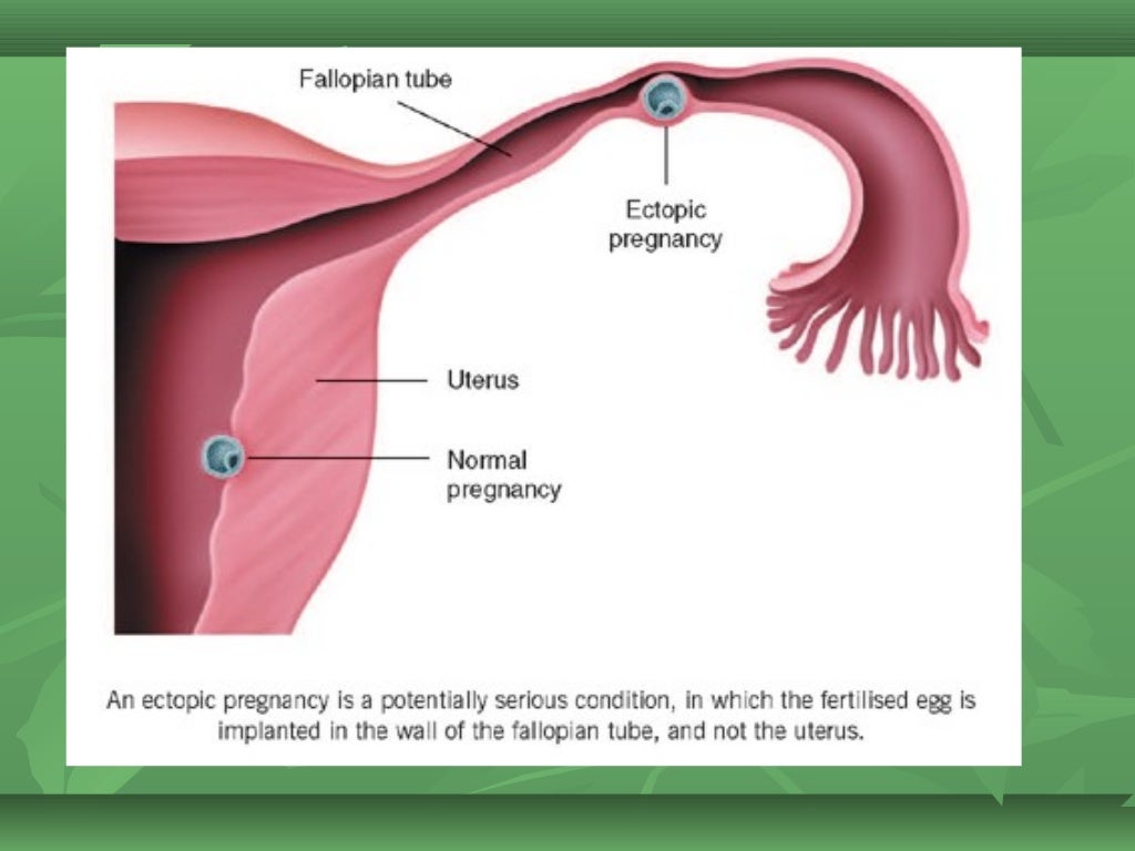 Ectopic pregnancy for undergraduate