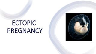 ECTOPIC
PREGNANCY
 