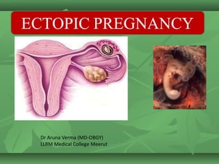 ECTOPIC PREGNANCY
Dr Aruna Verma (MD-OBGY)
LLRM Medical College Meerut
 