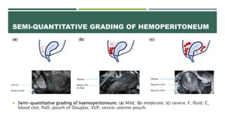 Ectopic Pregnancy: New ESHRE terminology | PPTX