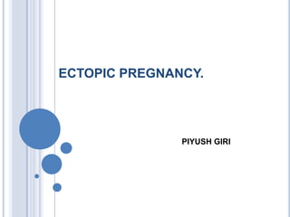 ECTOPIC PREGNANCY.
PIYUSH GIRI
 