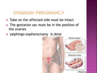  Tube on the affected side must be intact
 The gestation sac must be in the position of
the ovaries
 salphingo-oophorectomy is done
 