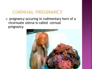  pregnancy occuring in rudimentary horn of a
vicornuate uterus is called cornual
pregnancy
 