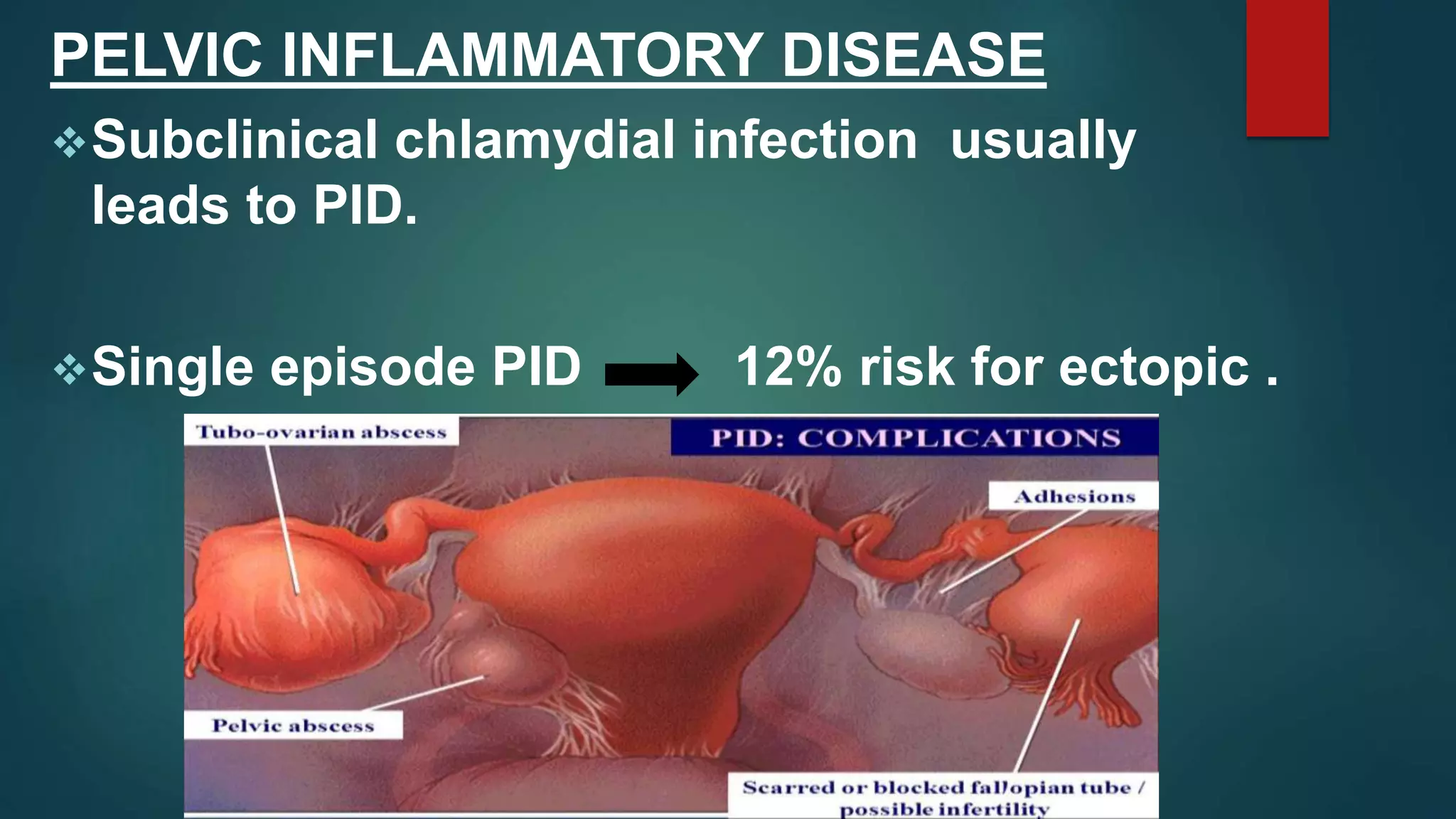 PELVIC INFLAMMATORY DISEASE
Subclinical chlamydial infection usually
leads to PID.
Single episode PID 12% risk for ectopic .
 