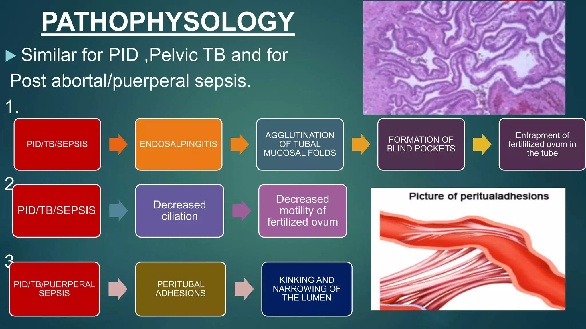 PATHOPHYSOLOGY
 Similar for PID ,Pelvic TB and for
Post abortal/puerperal sepsis.
1.
2.
3.
PID/TB/SEPSIS ENDOSALPINGITIS
AGGLUTINATION
OF TUBAL
MUCOSAL FOLDS
FORMATION OF
BLIND POCKETS
Entrapment of
fertililized ovum in
the tube
PID/TB/SEPSIS
Decreased
ciliation
Decreased
motility of
fertilized ovum
PID/TB/PUERPERAL
SEPSIS
PERITUBAL
ADHESIONS
KINKING AND
NARROWING OF
THE LUMEN
 