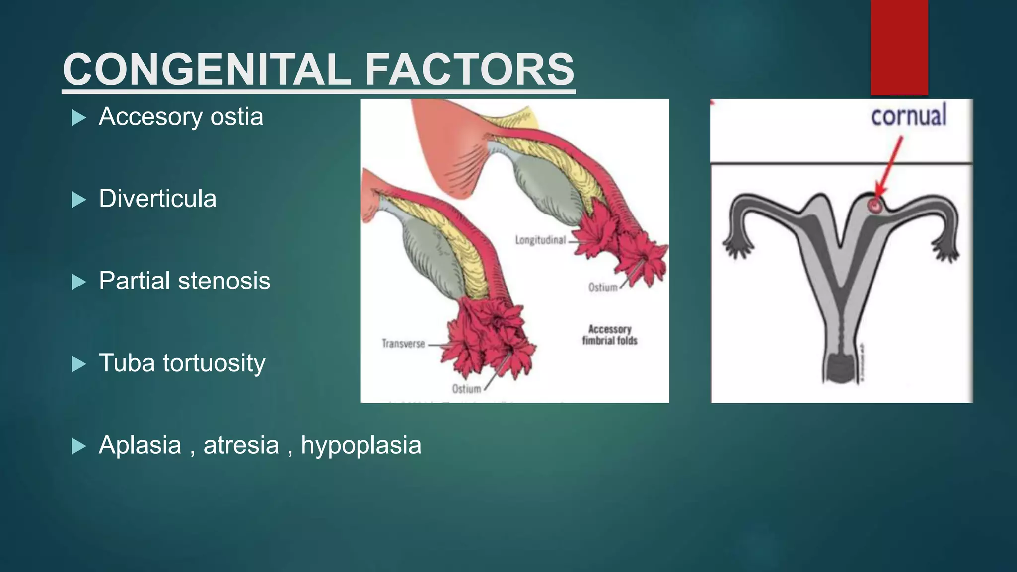 CONGENITAL FACTORS
 Accesory ostia
 Diverticula
 Partial stenosis
 Tuba tortuosity
 Aplasia , atresia , hypoplasia
 