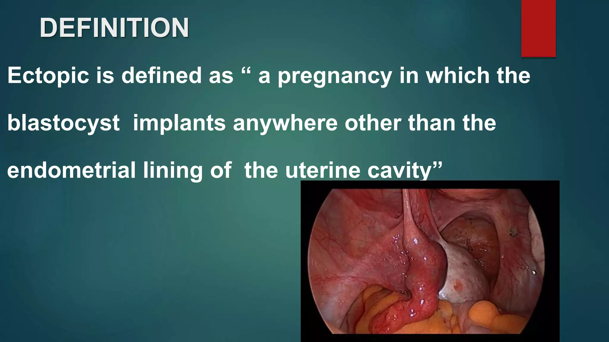 DEFINITION
Ectopic is defined as “ a pregnancy in which the
blastocyst implants anywhere other than the
endometrial lining of the uterine cavity”
 