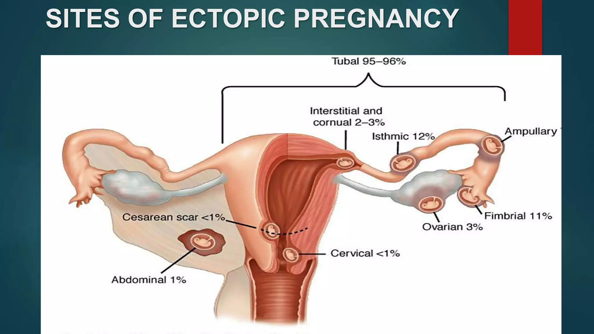 SITES OF ECTOPIC PREGNANCY
 