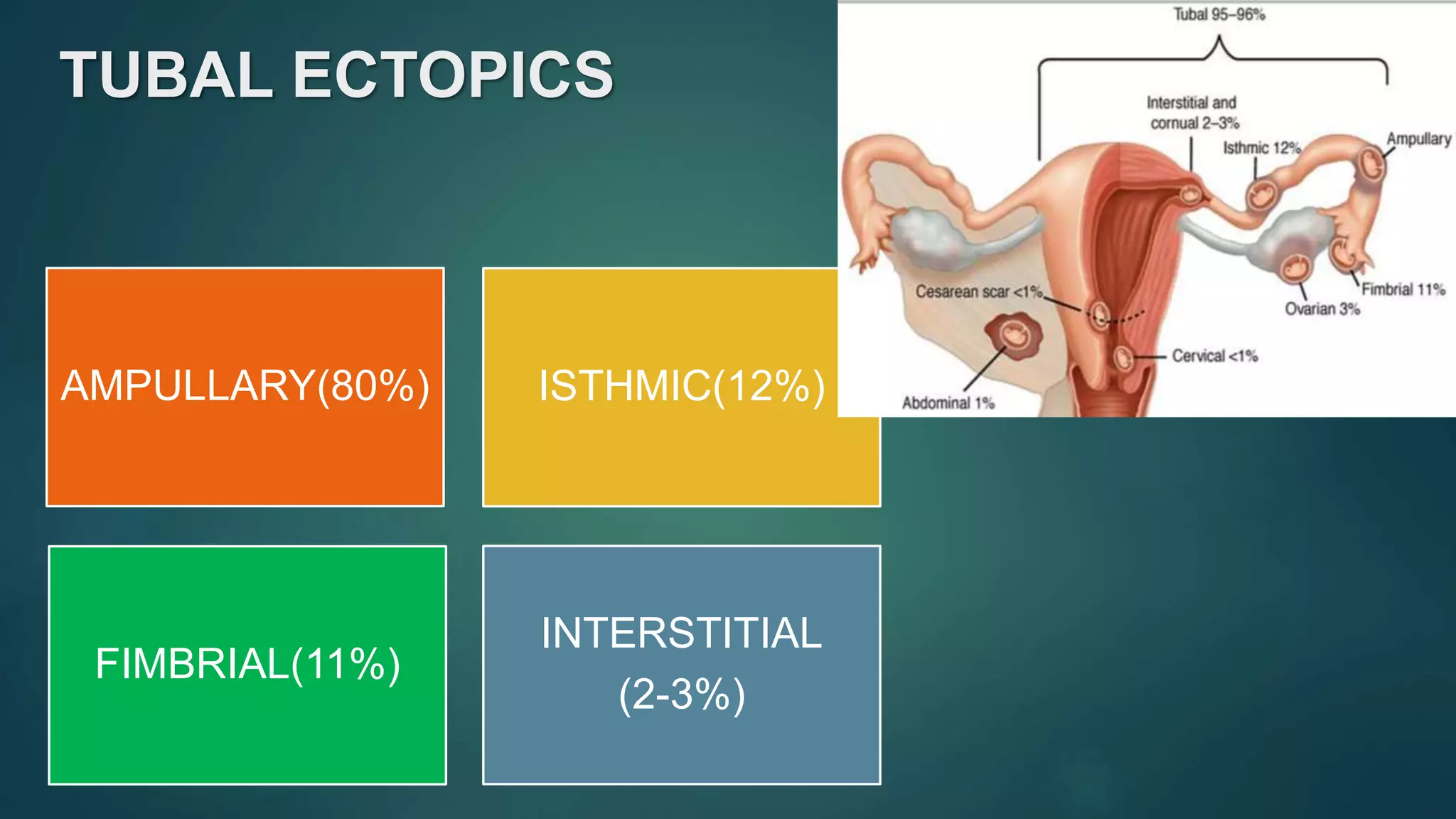 TUBAL ECTOPICS
AMPULLARY(80%) ISTHMIC(12%)
FIMBRIAL(11%)
INTERSTITIAL
(2-3%)
 