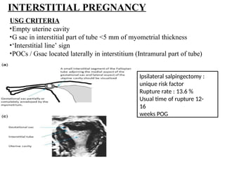 ectopic pregnancy concerning obstetric condition nowadays | PPTX