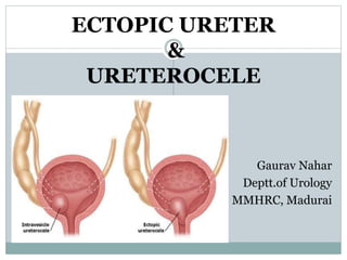 ECTOPIC URETER
&
URETEROCELE
Gaurav Nahar
Deptt.of Urology
MMHRC, Madurai
 