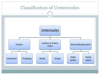 Classification of Ureteroceles
 