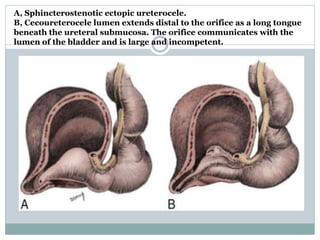 A, Sphincterostenotic ectopic ureterocele.
B, Cecoureterocele lumen extends distal to the orifice as a long tongue
beneath the ureteral submucosa. The orifice communicates with the
lumen of the bladder and is large and incompetent.
 