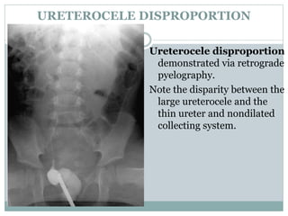 URETEROCELE DISPROPORTION
Ureterocele disproportion
demonstrated via retrograde
pyelography.
Note the disparity between the
large ureterocele and the
thin ureter and nondilated
collecting system.
 