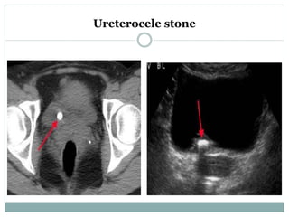 Ureterocele stone
 
