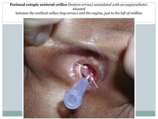 Perineal ectopic ureteral orifice (bottom arrow) cannulated with an angiocatheter,
situated
between the urethral orifice (top arrow) and the vagina, just to the left of midline
 