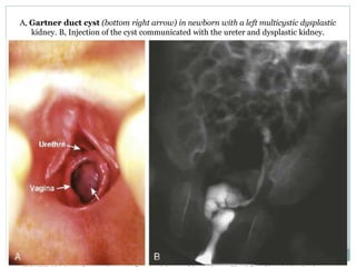 A, Gartner duct cyst (bottom right arrow) in newborn with a left multicystic dysplastic
kidney. B, Injection of the cyst communicated with the ureter and dysplastic kidney.
 