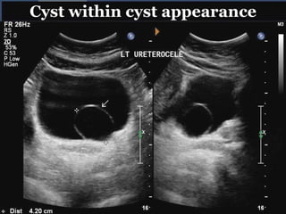 Cyst within cyst appearance
 