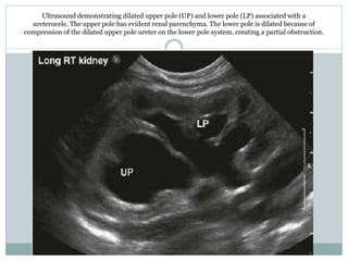 Ultrasound demonstrating dilated upper pole (UP) and lower pole (LP) associated with a
ureterocele. The upper pole has evident renal parenchyma. The lower pole is dilated because of
compression of the dilated upper pole ureter on the lower pole system, creating a partial obstruction.
 