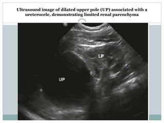 Ultrasound image of dilated upper pole (UP) associated with a
ureterocele, demonstrating limited renal parenchyma
 