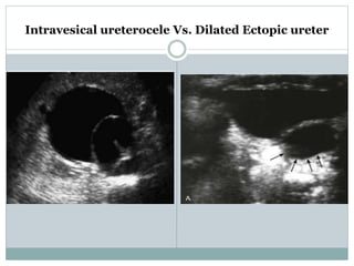 Intravesical ureterocele Vs. Dilated Ectopic ureter
 