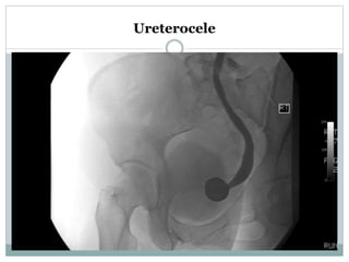 Ureterocele
 