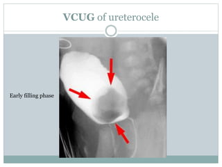 VCUG of ureterocele
Early filling phase
 